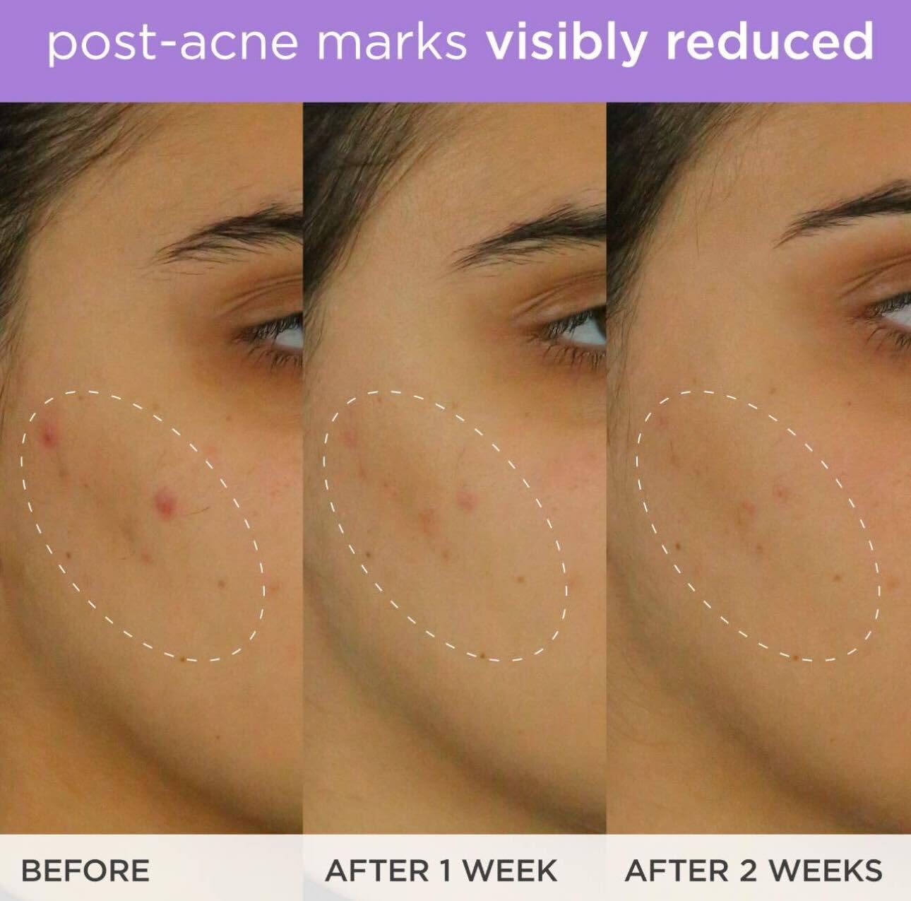 The Brightening Serum | Vitamin C Treatment for Brighter, Firmer Skin – Targets Hyperpigmentation & Fades Post-Acne Marks, 30 ml / 1.0 fl. oz. - Image 5