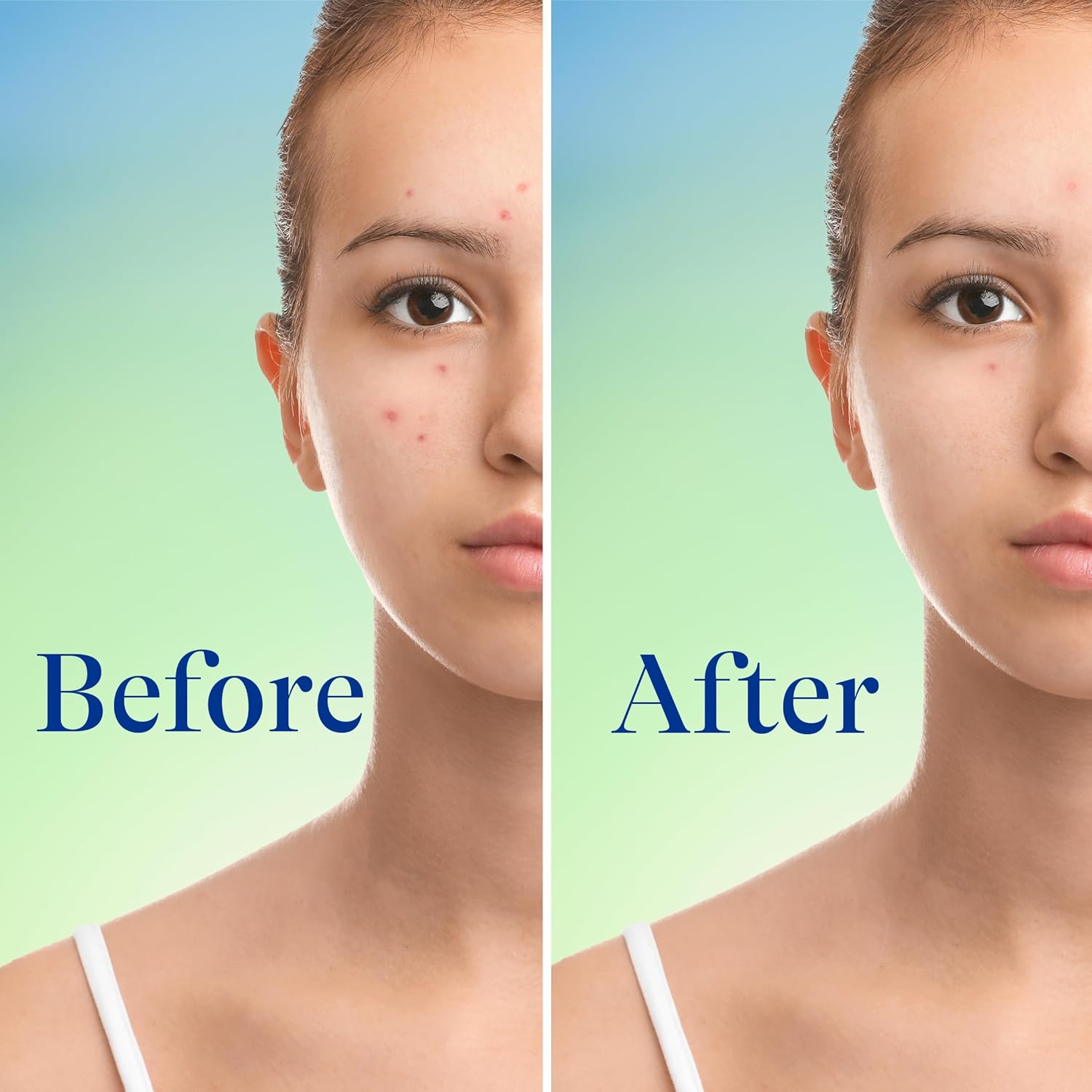 Differin Acne Face Wash with 10% Benzoyl Peroxide, Maximum Strength OTC Acne Foaming Cleanser, Fast Acting Acne Treatment for Face and Body, 5 oz. - Image 6