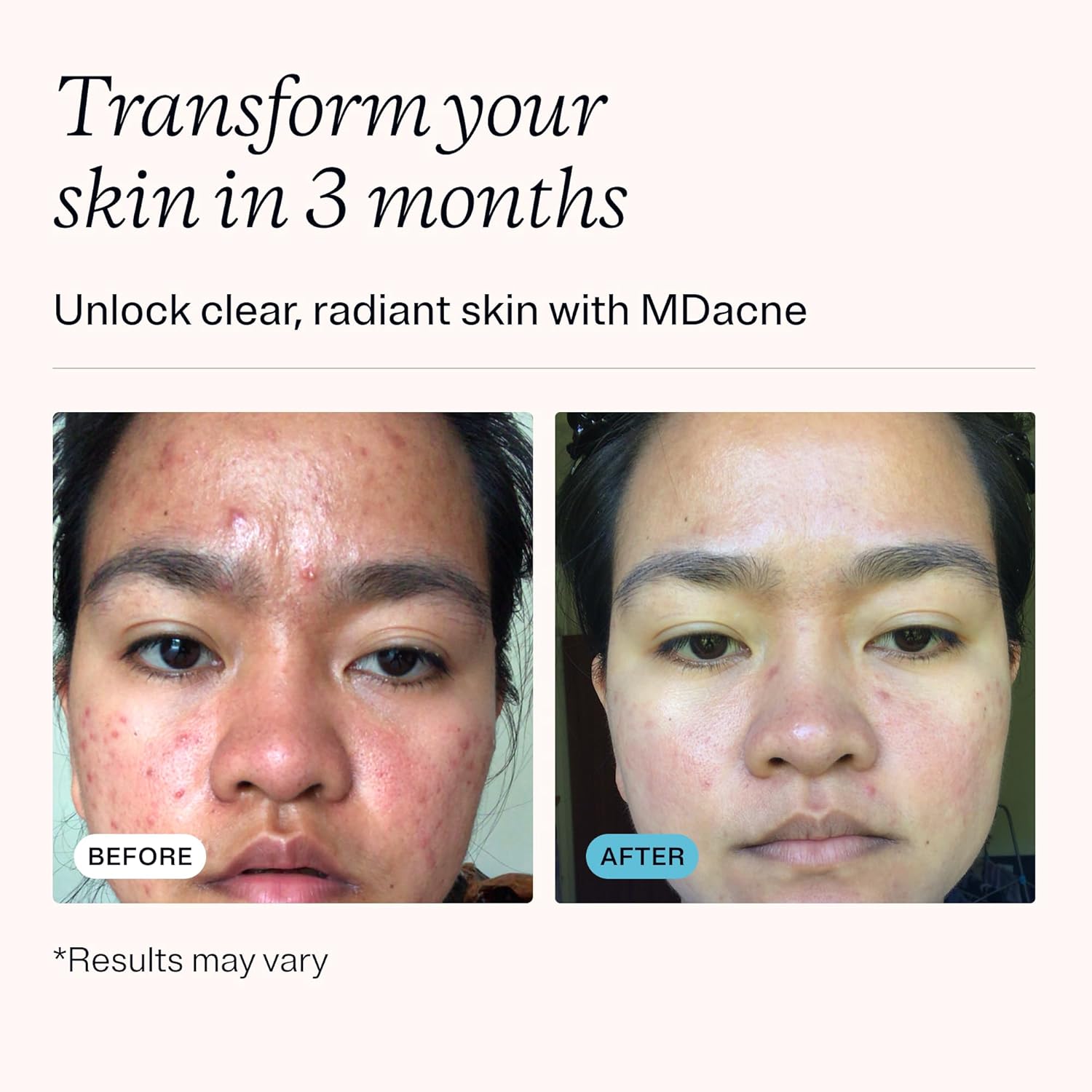 MDacne 3 Step Face Acne Treatment Kit, Benzoyl Peroxide Cream 2.5%, Salicylic Acid Cleanser, Niacinamide Moisturizer – Medicated Plant-Based Skincare for Adult & Teen Acne, 30 Day Kit - Image 3