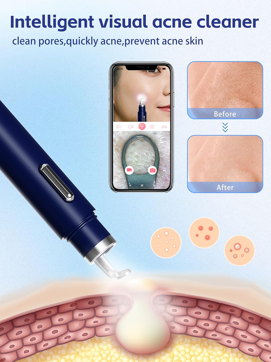 Visual Blackhead Remover Tools with Camera,Pimple Popper Extractor Tool Kit with Camera 20X 1080P Pore Cleaner Acne Comedone Whitehead Extractor Kit for iPhone/Android (Blue) - Image 3