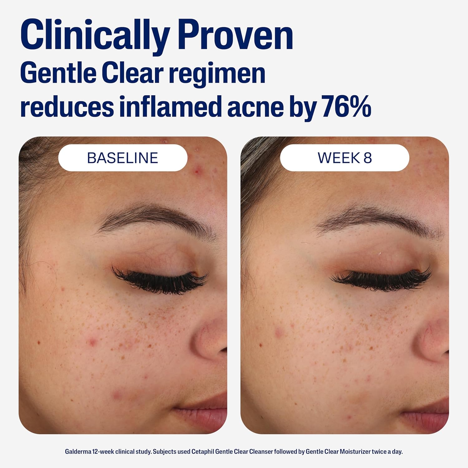 Cetaphil Face Moisturizer, Gentle Clear Mattifying Acne Moisturizer With 0.5% Salicylic Acid, Hydrates and Treats Sensitive Acne Prone Skin, Skin Care for Sensitive Skin, 3oz - Image 6