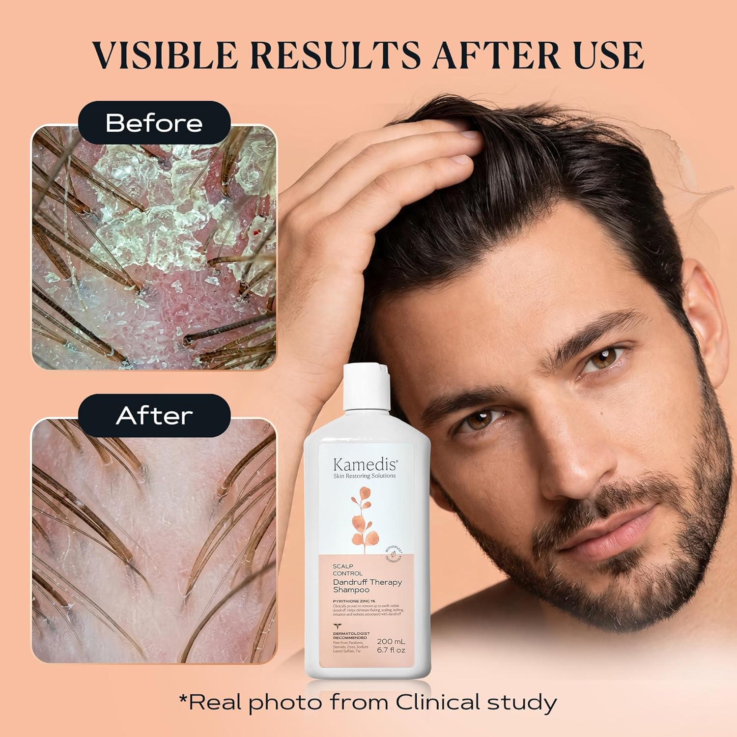 KAMEDIS Anti Dandruff Shampoo, Triple Power Formula: 1% Zinc Pyrithione, Salicylic Acid & Soap Nut Pure Extract. Itch, Flaky & Seborrheic Dermatitis Relief. Unisex. Parabens & Dyes Free. 16.9 Fl Oz - Image 3