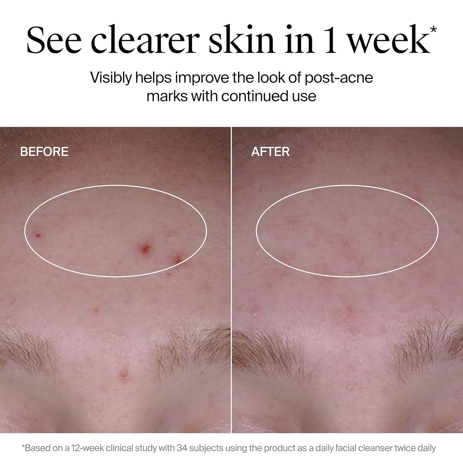 Neutrogena Evenly Clear Acne Cleanser with 2% Salicylic Acid & 2% PHA Exfoliant, Gentle Foaming Face Wash Clears Clogged Pores & Blackheads While Visibly Fading Look of Post-Acne Marks, 9.1 fl. oz - Image 6
